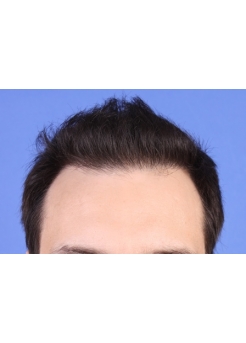 After Hair Transplant&nbsp;Front